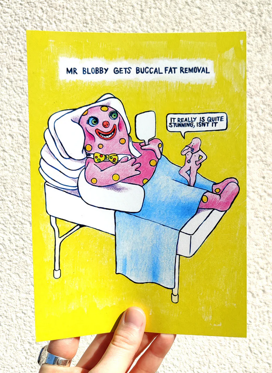 Buccal fat Removal